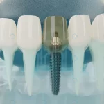 close up component dental implants transparent 3d crc0ce75122 size13.06mb 7800x5200 - title:Home - اورچین فایل - format: - sku: - keywords:وکتور,موکاپ,افکت متنی,پروژه افترافکت p_id:63922