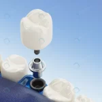 close up component dental implants transparent 3d crc375dab75 size7.75mb 7800x4550 - title:Home - اورچین فایل - format: - sku: - keywords:وکتور,موکاپ,افکت متنی,پروژه افترافکت p_id:63922