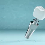 dental implant dental prosthesis 3d rendering crc3c50896a size2.27mb 5396x3000 - title:Home - اورچین فایل - format: - sku: - keywords:وکتور,موکاپ,افکت متنی,پروژه افترافکت p_id:63922