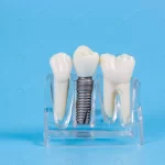 plastic dental crowns imitation dental prosthesis crc28d866c0 size8.81mb 5760x3840 - title:Home - اورچین فایل - format: - sku: - keywords:وکتور,موکاپ,افکت متنی,پروژه افترافکت p_id:63922