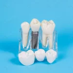 plastic dental crowns imitation dental prosthesis crcf0da4002 size8.82mb 3408x5088 - title:Home - اورچین فایل - format: - sku: - keywords:وکتور,موکاپ,افکت متنی,پروژه افترافکت p_id:63922
