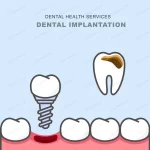 dental implant instead carious tooth teeth prosth crca65ed5b5 size1.03mb - title:Home - اورچین فایل - format: - sku: - keywords:وکتور,موکاپ,افکت متنی,پروژه افترافکت p_id:63922