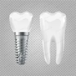 dental implant realistic healthy tooth implant de crc557a9647 size1.41mb - title:Home - اورچین فایل - format: - sku: - keywords:وکتور,موکاپ,افکت متنی,پروژه افترافکت p_id:63922