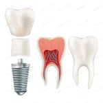 dental implant set crc0c12bd4b size2.91mb - title:Home - اورچین فایل - format: - sku: - keywords:وکتور,موکاپ,افکت متنی,پروژه افترافکت p_id:63922