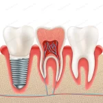 dental implant set crcf8e807c7 size6.76mb - title:Home - اورچین فایل - format: - sku: - keywords:وکتور,موکاپ,افکت متنی,پروژه افترافکت p_id:63922