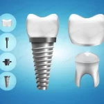dental implant structure crown restoration realis crc1c78ba67 size4.84mb - title:Home - اورچین فایل - format: - sku: - keywords:وکتور,موکاپ,افکت متنی,پروژه افترافکت p_id:63922