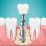 dental surgery tooth implant cut illustration hea crc01aa471f size2.15mb - title:Home - اورچین فایل - format: - sku: - keywords:وکتور,موکاپ,افکت متنی,پروژه افترافکت p_id:63922