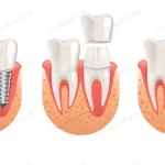 teeth procedure implant veneer crown restoration crc0e2e45e2 size2.11mb - title:Home - اورچین فایل - format: - sku: - keywords:وکتور,موکاپ,افکت متنی,پروژه افترافکت p_id:63922