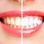 woman teeth before after whitening image symboliz crc3eb3574f size4.16mb 3057x2038 - title:Home - اورچین فایل - format: - sku: - keywords:وکتور,موکاپ,افکت متنی,پروژه افترافکت p_id:63922